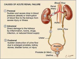 Renal Failure